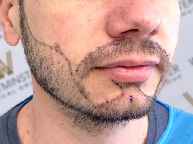 Beard Transplant FollicleX