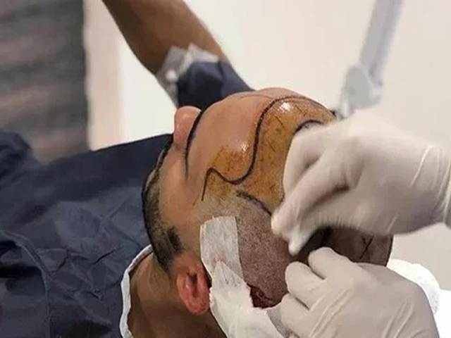 FUE Hair Transplant FollicleX