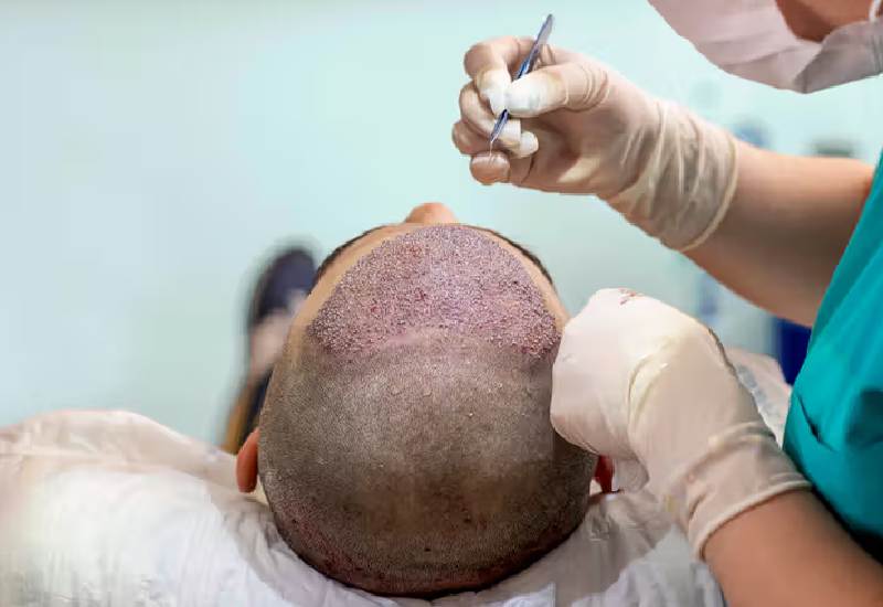 FUE Hair Transplant folliclex